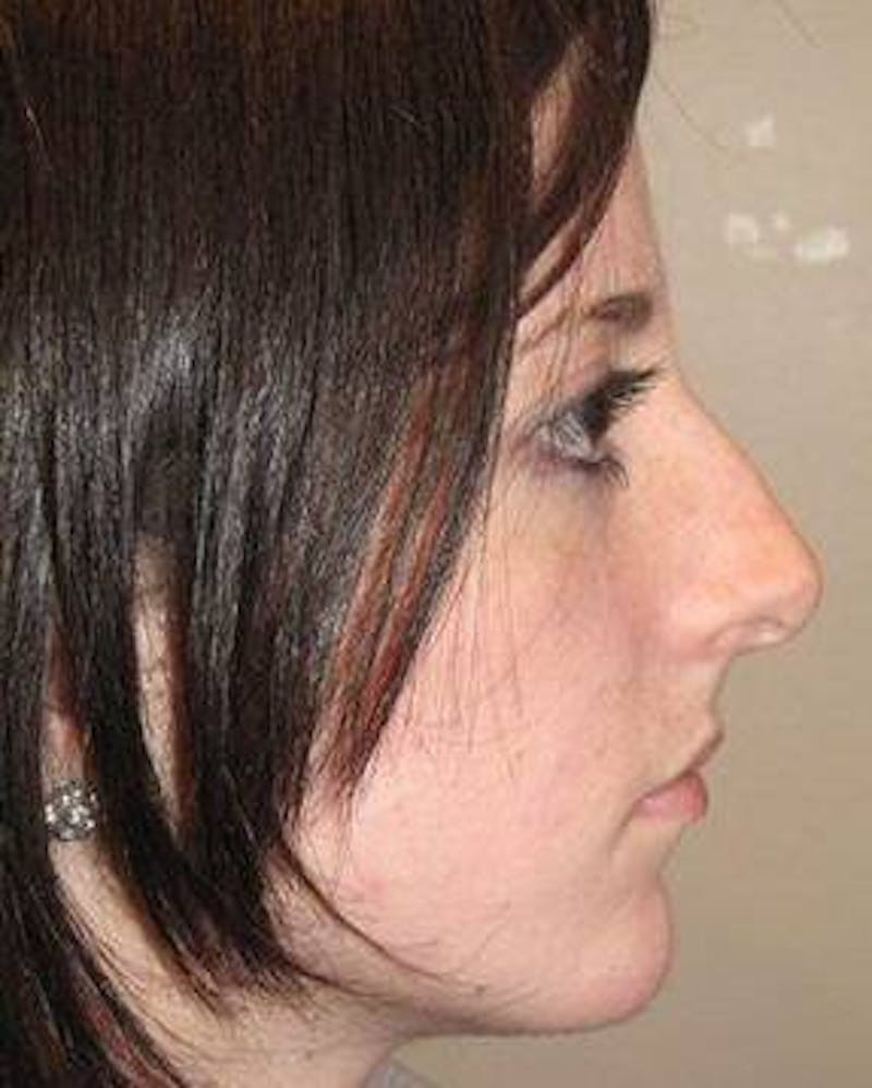 Rhinoplasty Before & After Gallery - Patient 181617 - Image 1 - Scott Chapin, MD