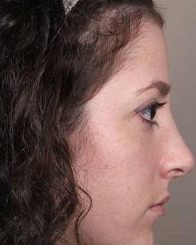 Rhinoplasty Before & After Gallery - Patient 181617 - Image 2 - Scott Chapin, MD