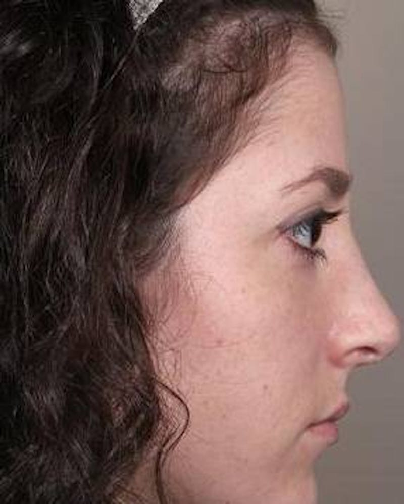 Rhinoplasty Before & After Gallery - Patient 181617 - Image 2 - Scott Chapin, MD
