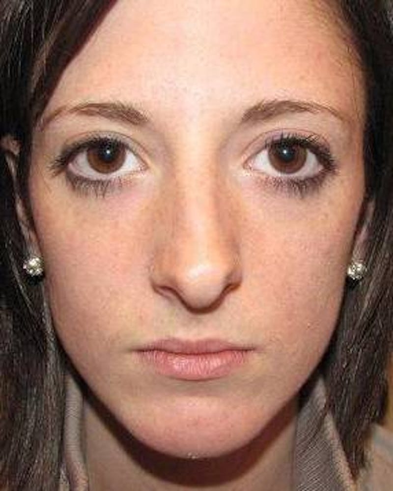 Rhinoplasty Before & After Gallery - Patient 181617 - Image 3 - Scott Chapin, MD