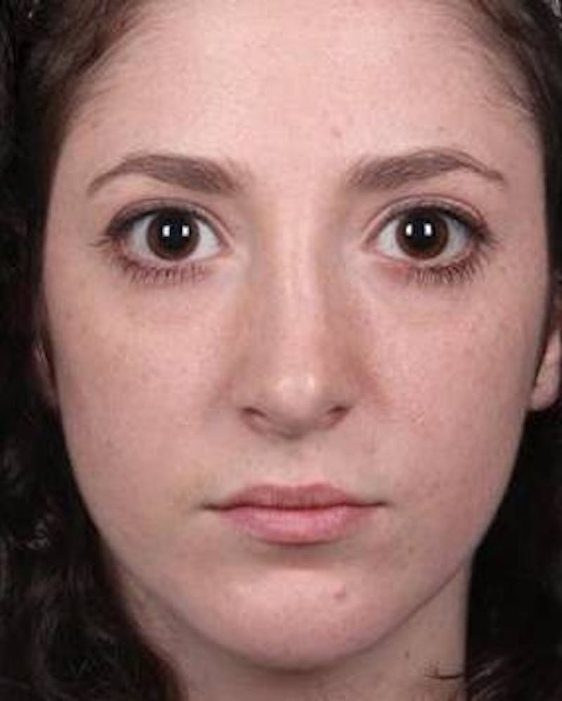 Rhinoplasty Before & After Gallery - Patient 181617 - Image 4 - Scott Chapin, MD