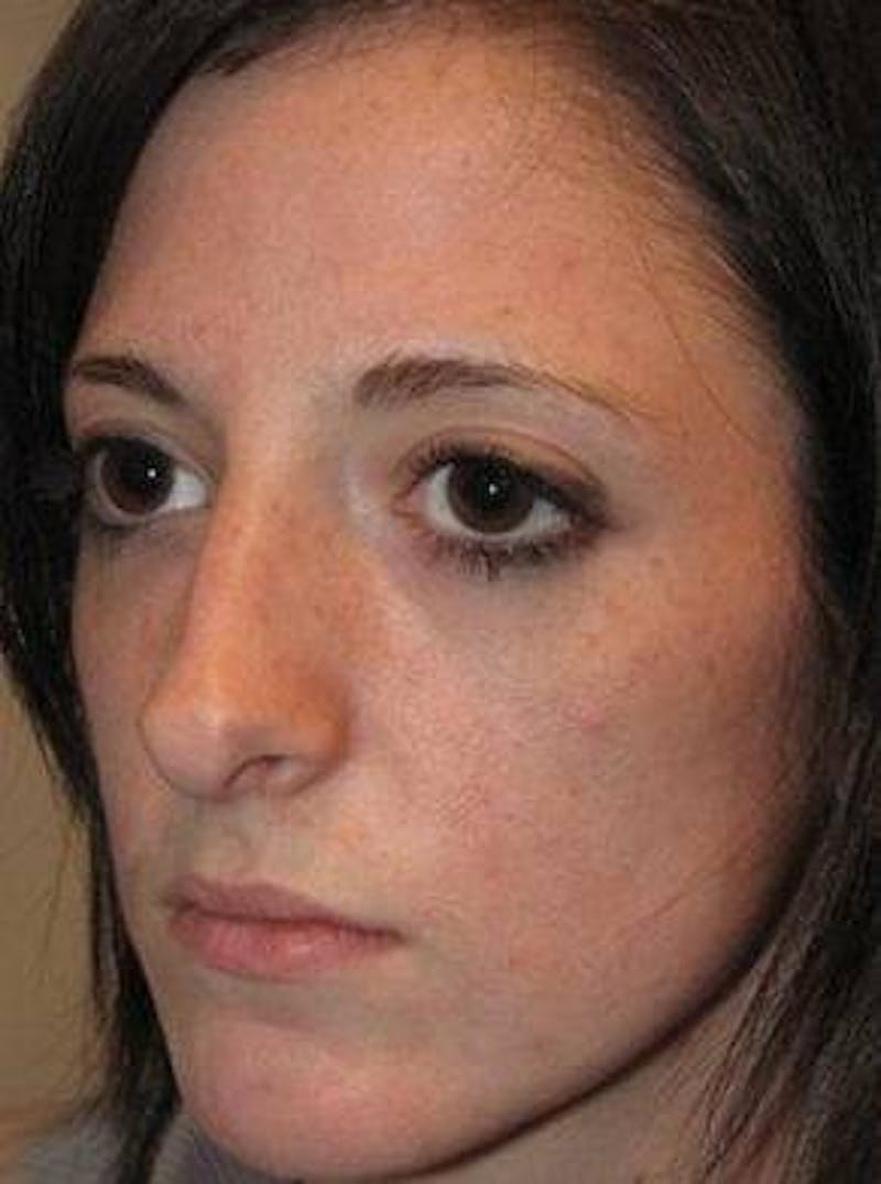 Rhinoplasty Before & After Gallery - Patient 181617 - Image 5 - Scott Chapin, MD