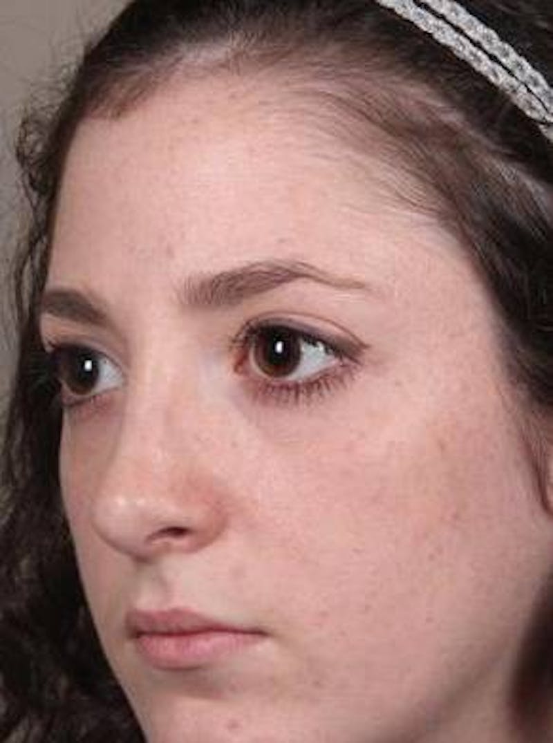 Rhinoplasty Before & After Gallery - Patient 181617 - Image 6 - Scott Chapin, MD
