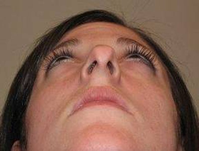 Rhinoplasty Before & After Gallery - Patient 181617 - Image 7 - Scott Chapin, MD