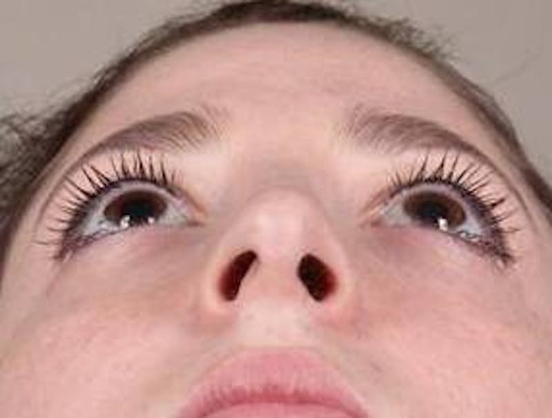 Rhinoplasty Before & After Gallery - Patient 181617 - Image 8 - Scott Chapin, MD