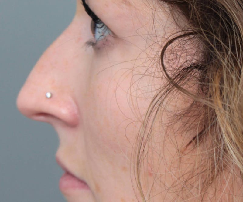 Rhinoplasty Before & After Gallery - Patient 210426 - Image 1 - Scott Chapin, MD