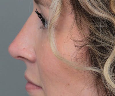 Rhinoplasty Before & After Gallery - Patient 210426 - Image 2 - Scott Chapin, MD