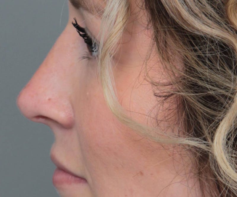 Rhinoplasty Before & After Gallery - Patient 210426 - Image 2 - Scott Chapin, MD