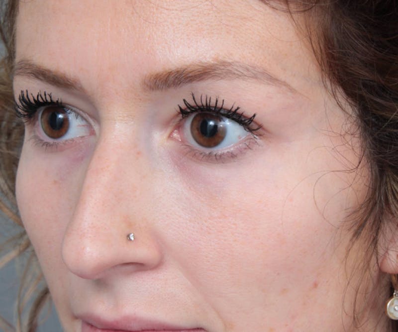Rhinoplasty Before & After Gallery - Patient 210426 - Image 5 - Scott Chapin, MD