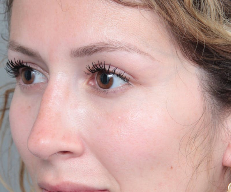 Rhinoplasty Before & After Gallery - Patient 210426 - Image 6 - Scott Chapin, MD