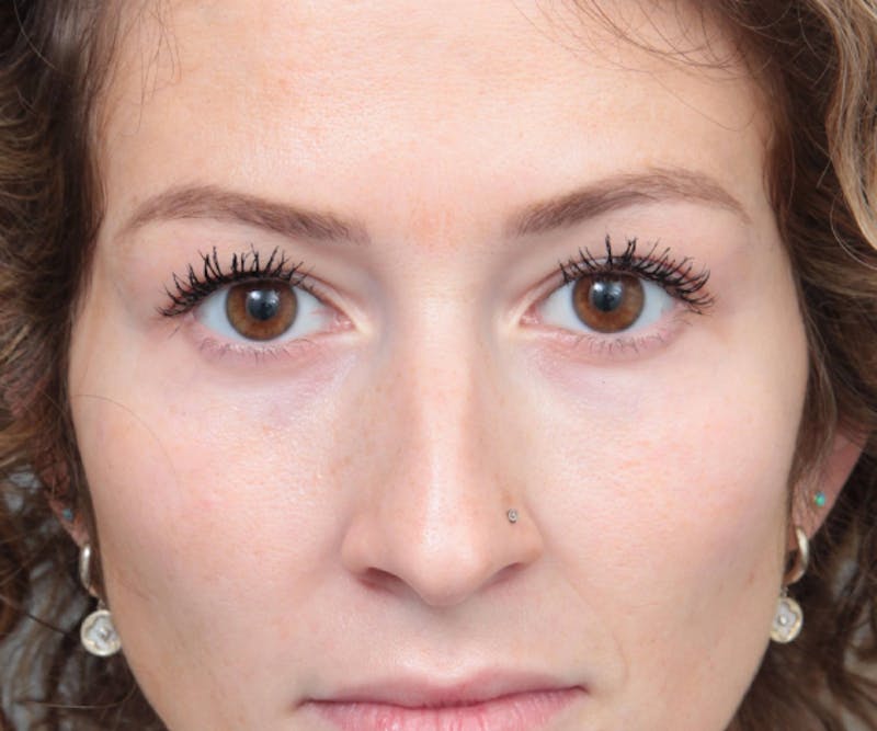 Rhinoplasty Before & After Gallery - Patient 210426 - Image 7 - Scott Chapin, MD