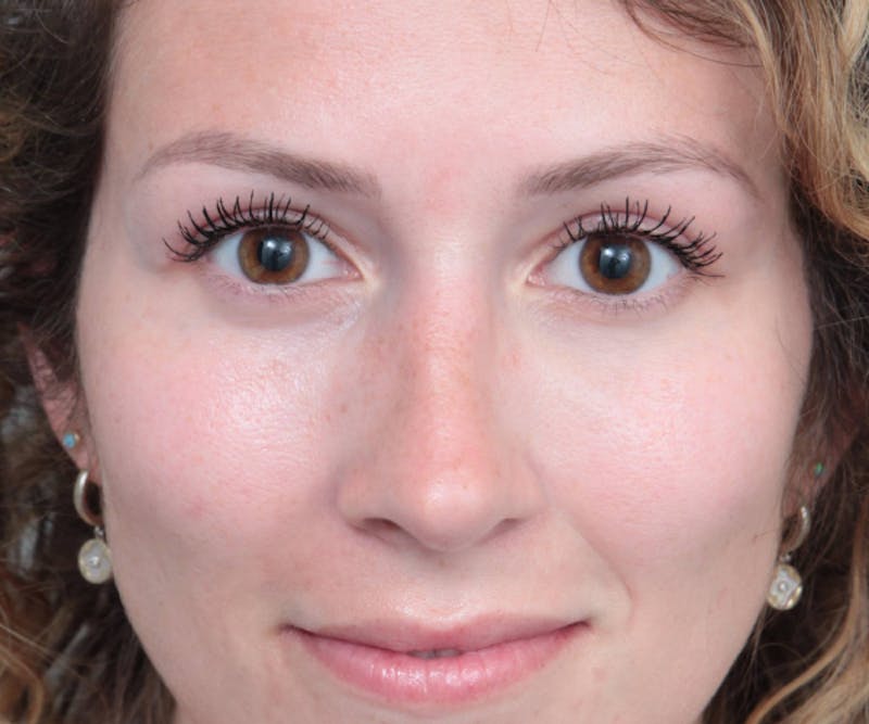 Rhinoplasty Before & After Gallery - Patient 210426 - Image 8 - Scott Chapin, MD