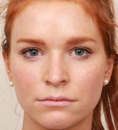 Rhinoplasty Before & After Gallery - Patient 984830 - Image 1 - Scott Chapin, MD
