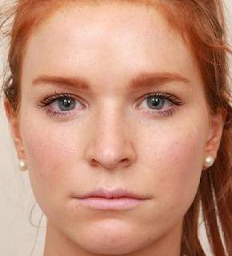 Rhinoplasty Before & After Gallery - Patient 984830 - Image 1 - Scott Chapin, MD