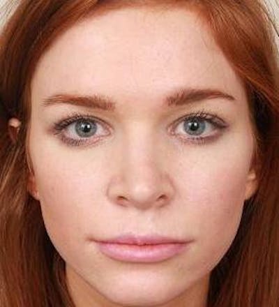Rhinoplasty Before & After Gallery - Patient 984830 - Image 2 - Scott Chapin, MD
