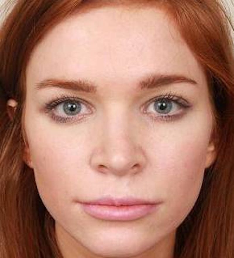 Rhinoplasty Before & After Gallery - Patient 984830 - Image 2 - Scott Chapin, MD