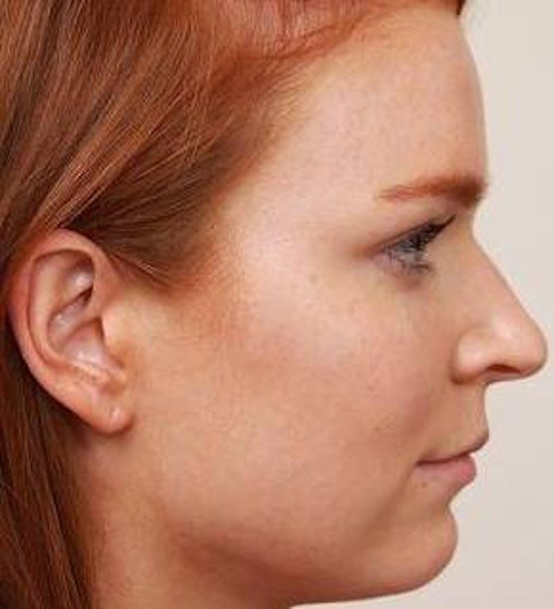 Rhinoplasty Before & After Gallery - Patient 984830 - Image 3 - Scott Chapin, MD