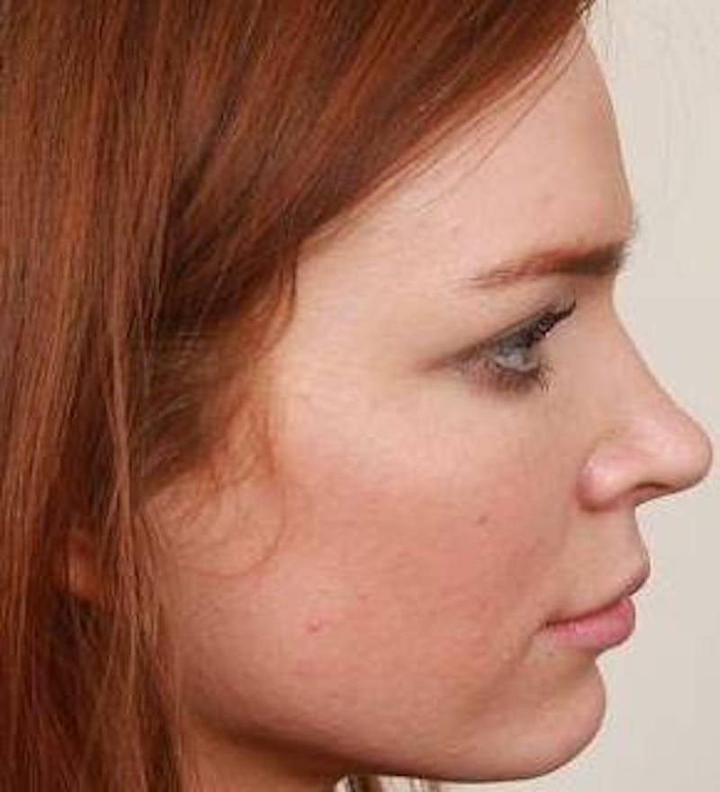 Rhinoplasty Before & After Gallery - Patient 984830 - Image 4 - Scott Chapin, MD