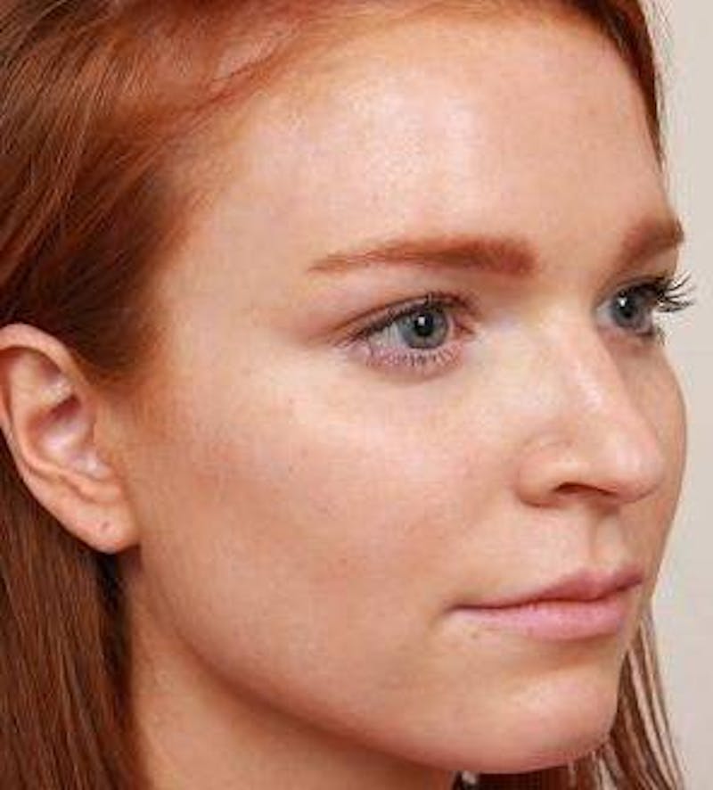 Rhinoplasty Before & After Gallery - Patient 984830 - Image 5 - Scott Chapin, MD