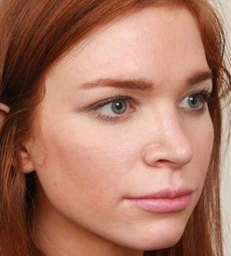 Rhinoplasty Before & After Gallery - Patient 984830 - Image 6 - Scott Chapin, MD