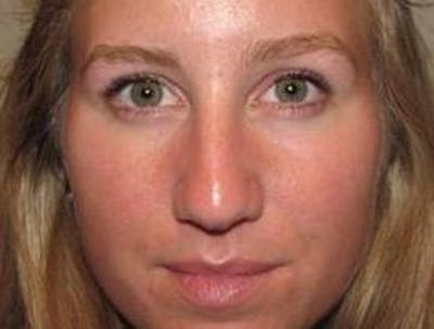 Rhinoplasty Before & After Gallery - Patient 195381 - Image 1 - Scott Chapin, MD