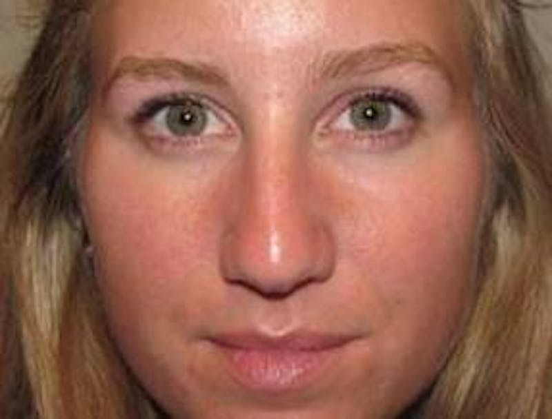 Rhinoplasty Before & After Gallery - Patient 195381 - Image 1 - Scott Chapin, MD