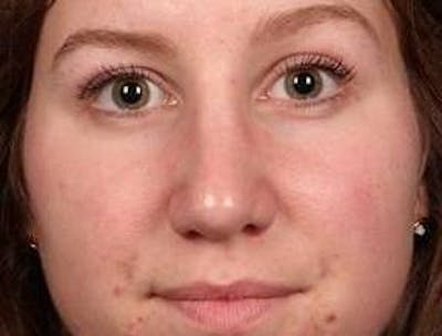 Rhinoplasty Before & After Gallery - Patient 195381 - Image 2 - Scott Chapin, MD