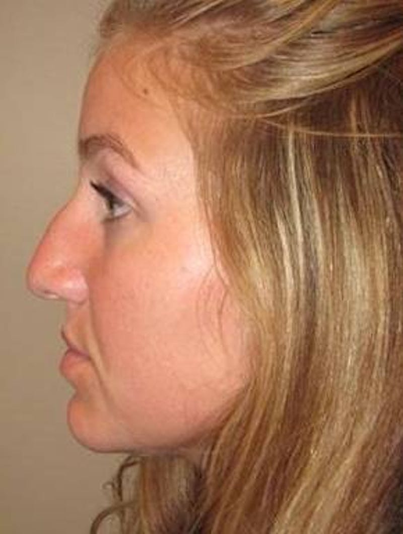 Rhinoplasty Before & After Gallery - Patient 195381 - Image 3 - Scott Chapin, MD