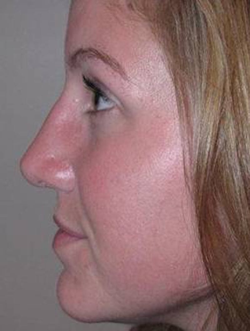 Rhinoplasty Before & After Gallery - Patient 195381 - Image 4 - Scott Chapin, MD