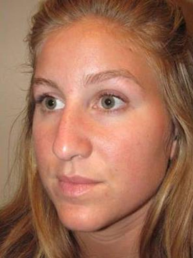 Rhinoplasty Before & After Gallery - Patient 195381 - Image 5 - Scott Chapin, MD