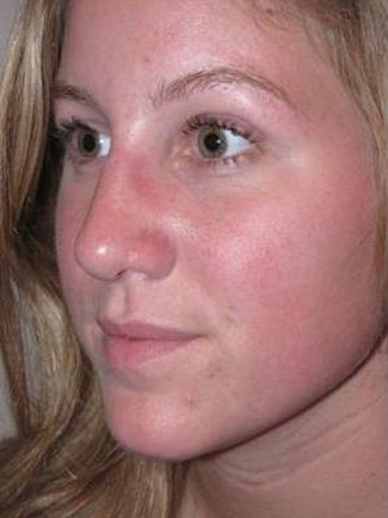 Rhinoplasty Before & After Gallery - Patient 195381 - Image 6 - Scott Chapin, MD