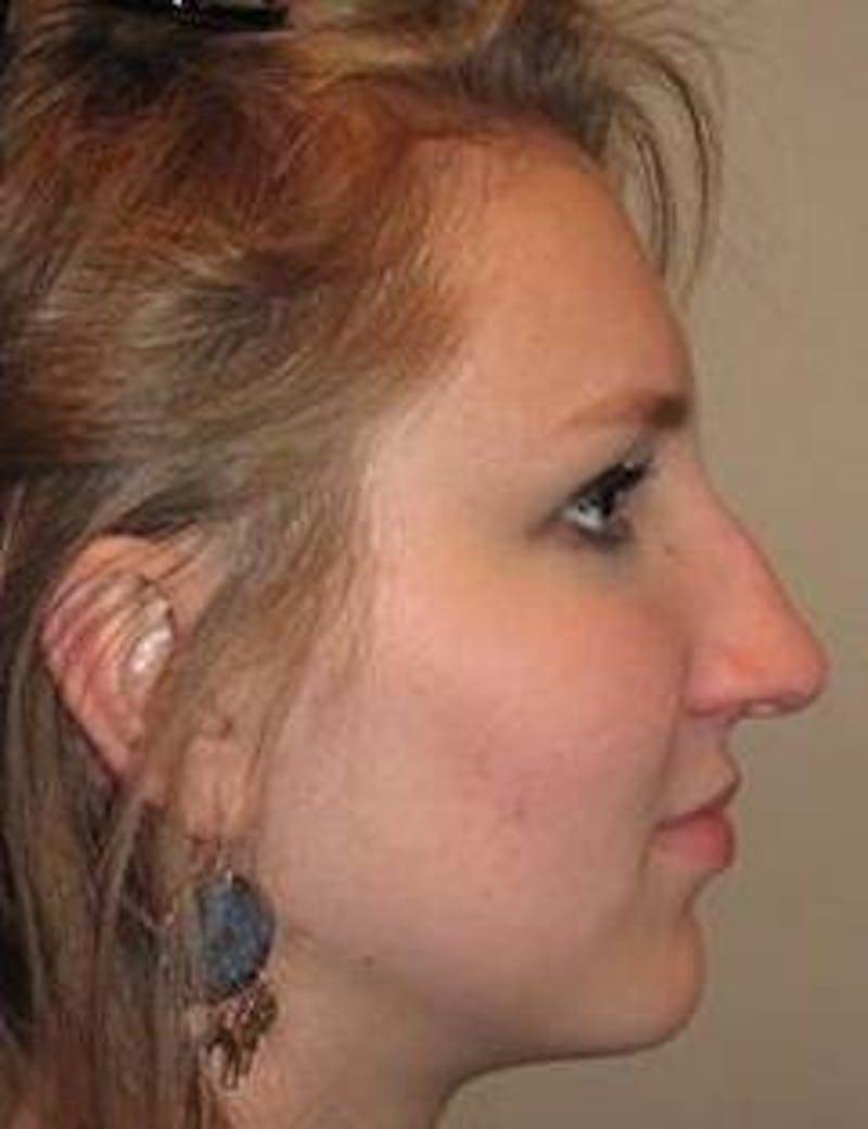 Rhinoplasty Before & After Gallery - Patient 172680 - Image 1 - Scott Chapin, MD