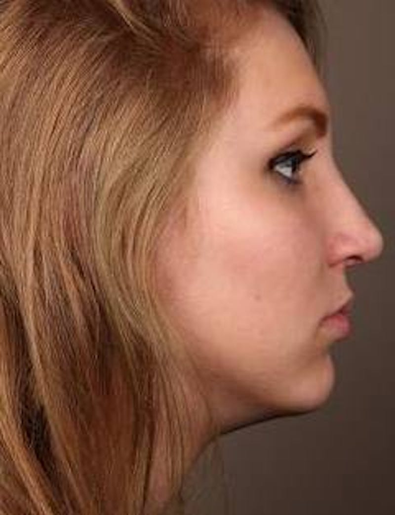 Rhinoplasty Before & After Gallery - Patient 172680 - Image 2 - Scott Chapin, MD