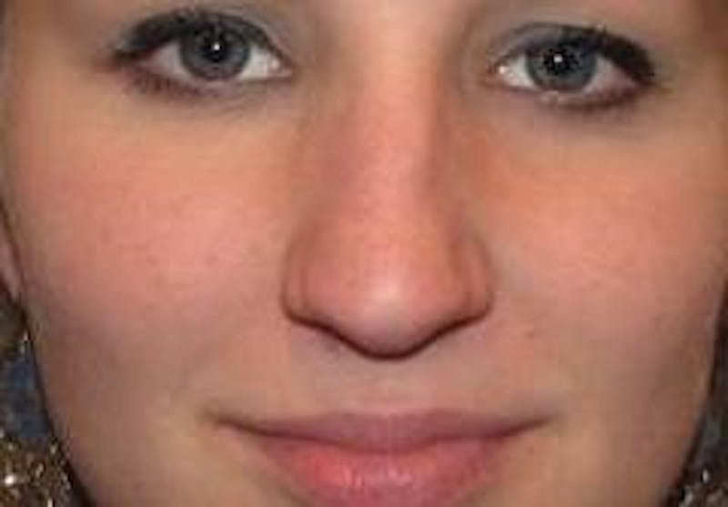 Rhinoplasty Before & After Gallery - Patient 172680 - Image 3 - Scott Chapin, MD