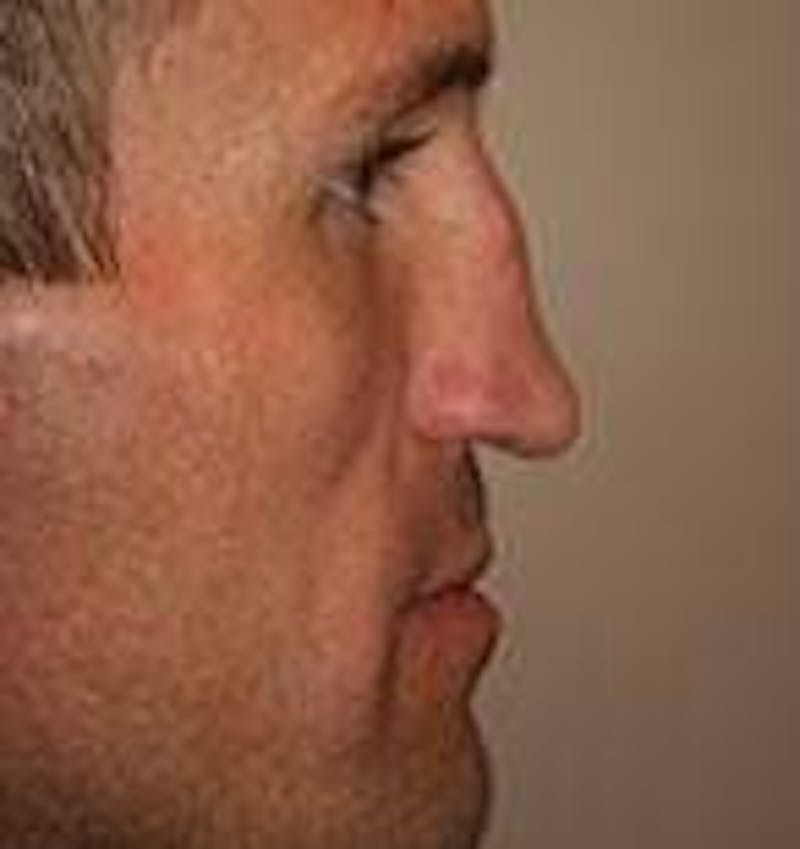 Rhinoplasty Before & After Gallery - Patient 395388 - Image 1 - Scott Chapin, MD