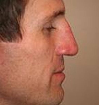 Rhinoplasty Before & After Gallery - Patient 395388 - Image 2 - Scott Chapin, MD