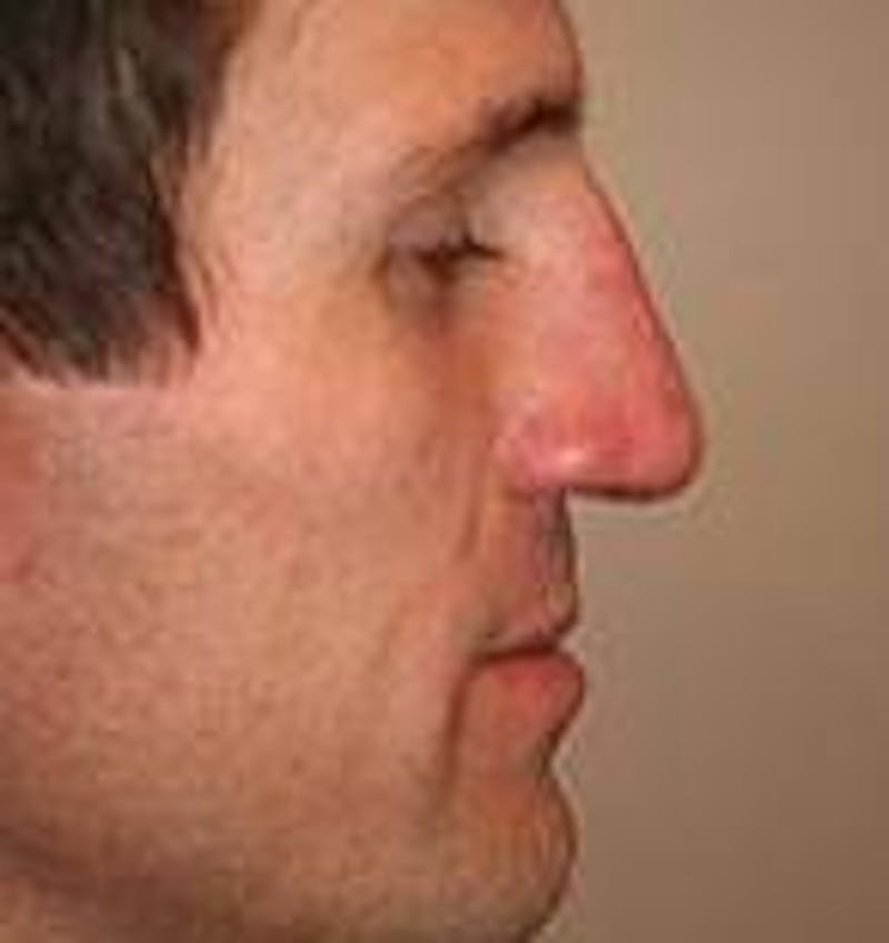 Rhinoplasty Before & After Gallery - Patient 395388 - Image 2 - Scott Chapin, MD