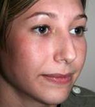 Rhinoplasty Before & After Gallery - Patient 433630 - Image 1 - Scott Chapin, MD