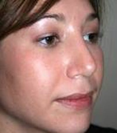 Rhinoplasty Before & After Gallery - Patient 433630 - Image 2 - Scott Chapin, MD