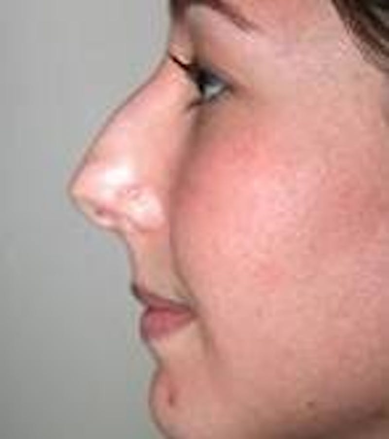 Rhinoplasty Before & After Gallery - Patient 433630 - Image 3 - Scott Chapin, MD