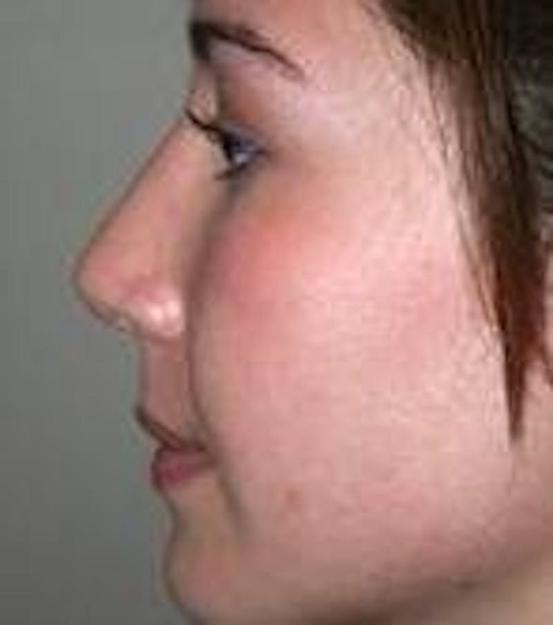 Rhinoplasty Before & After Gallery - Patient 433630 - Image 4 - Scott Chapin, MD