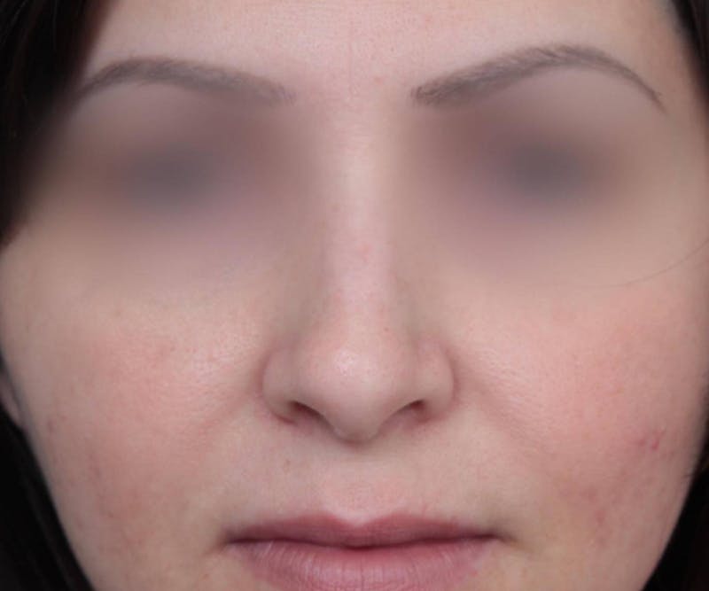 Rhinoplasty Before & After Gallery - Patient 286762 - Image 1 - Scott Chapin, MD