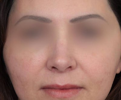 Rhinoplasty Before & After Gallery - Patient 286762 - Image 2 - Scott Chapin, MD
