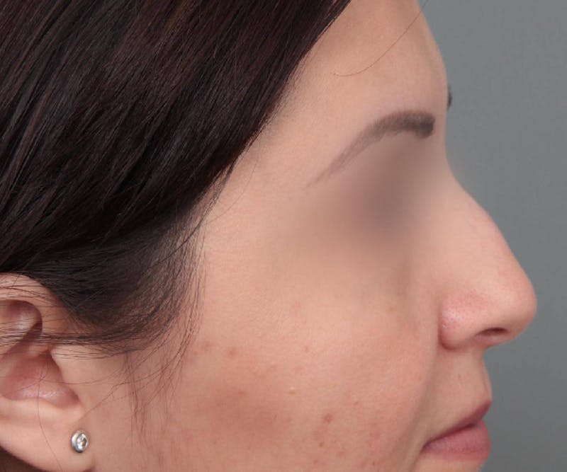 Rhinoplasty Before & After Gallery - Patient 286762 - Image 3 - Scott Chapin, MD