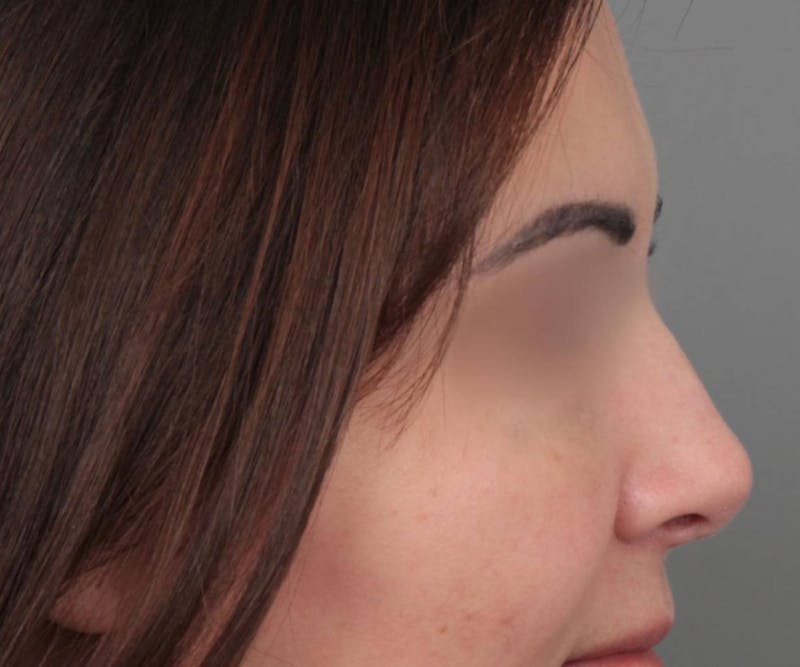 Rhinoplasty Before & After Gallery - Patient 286762 - Image 4 - Scott Chapin, MD