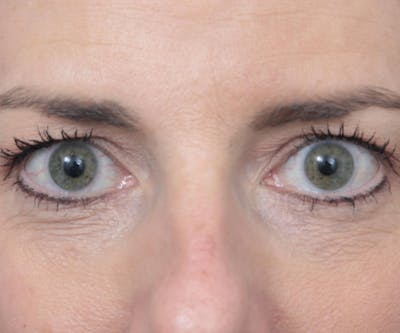 Laser Skin Resurfacing Before & After Gallery - Patient 292515 - Image 1 - Scott Chapin, MD
