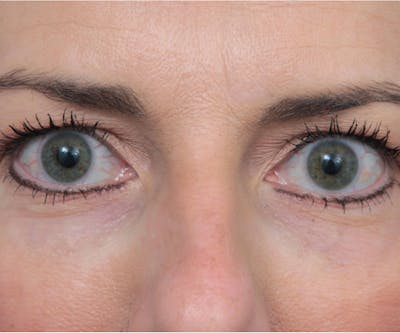 Laser Skin Resurfacing Before & After Gallery - Patient 292515 - Image 2 - Scott Chapin, MD