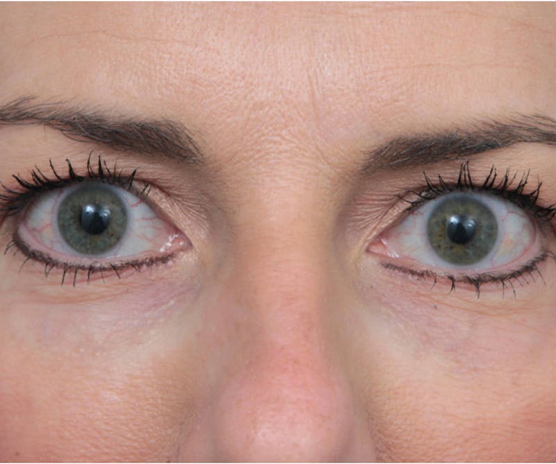 Laser Skin Resurfacing Before & After Gallery - Patient 292515 - Image 2 - Scott Chapin, MD