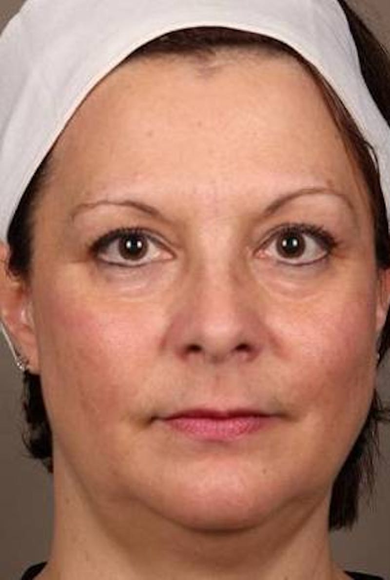Laser Skin Resurfacing Before & After Gallery - Patient 161983 - Image 1 - Scott Chapin, MD
