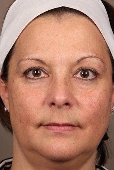 Laser Skin Resurfacing Before & After Gallery - Patient 161983 - Image 2 - Scott Chapin, MD